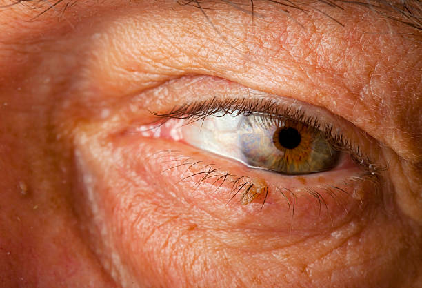 istock Skin Wart Growing on an Eyelid 182661103