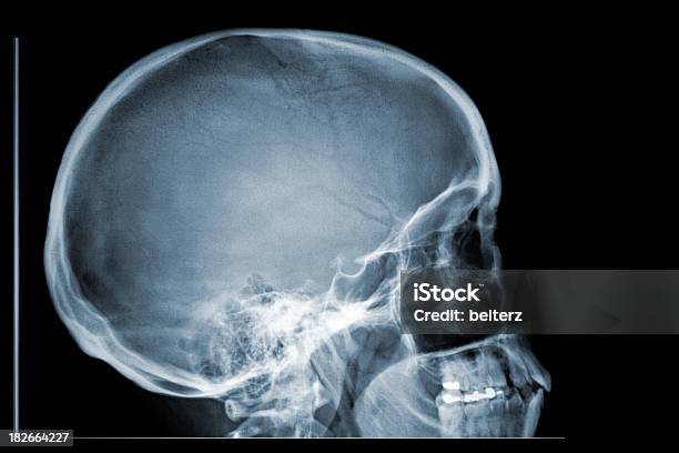 Xray Crânio Perfil Lateral - Fotografias de stock e mais imagens de Imagem de raios X - Imagem de raios X, Perfil - Vista Lateral, Obturação