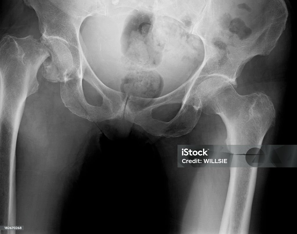 Цифровой рентгенограмме таза с трещинами на правом бедре - Стоковые фото Перелом роялти-фри