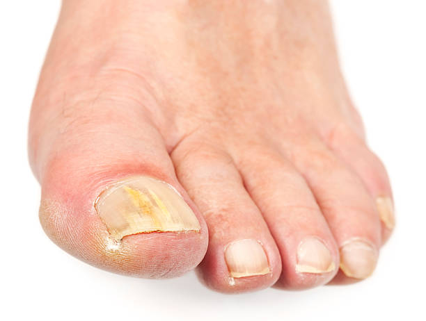 unghia del piede funghi (isolato su bianco - podiatrist pedicure human foot toenail foto e immagini stock