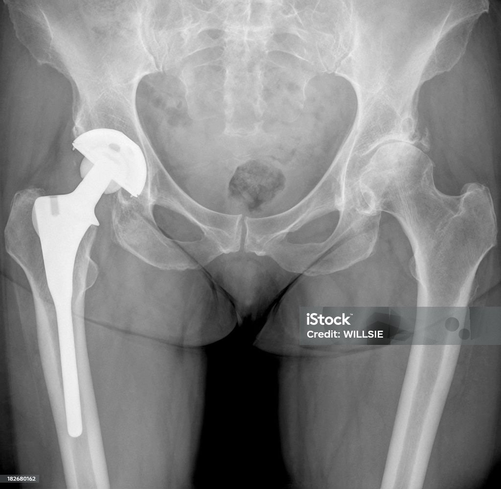 À direita do quadril de reposição total digital pélvica raio-x para Osteoartrite - Foto de stock de Bacia Artificial royalty-free