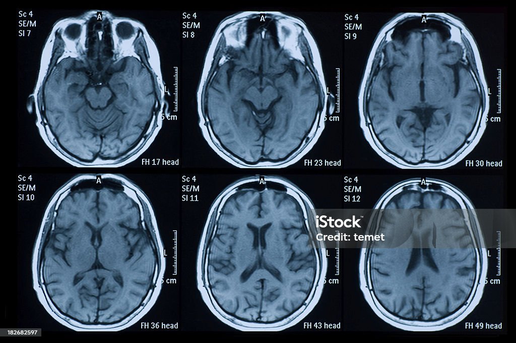 Cerebro - Foto de stock de Imagen de resonancia magnética libre de derechos