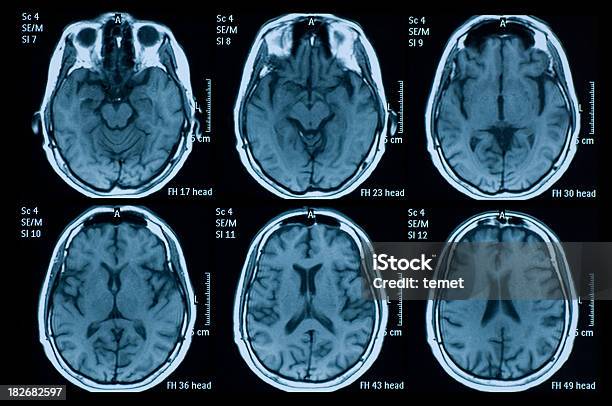 Cerebro Foto de stock y más banco de imágenes de Imagen de resonancia magnética - Imagen de resonancia magnética, Escáner IRM, Cerebro