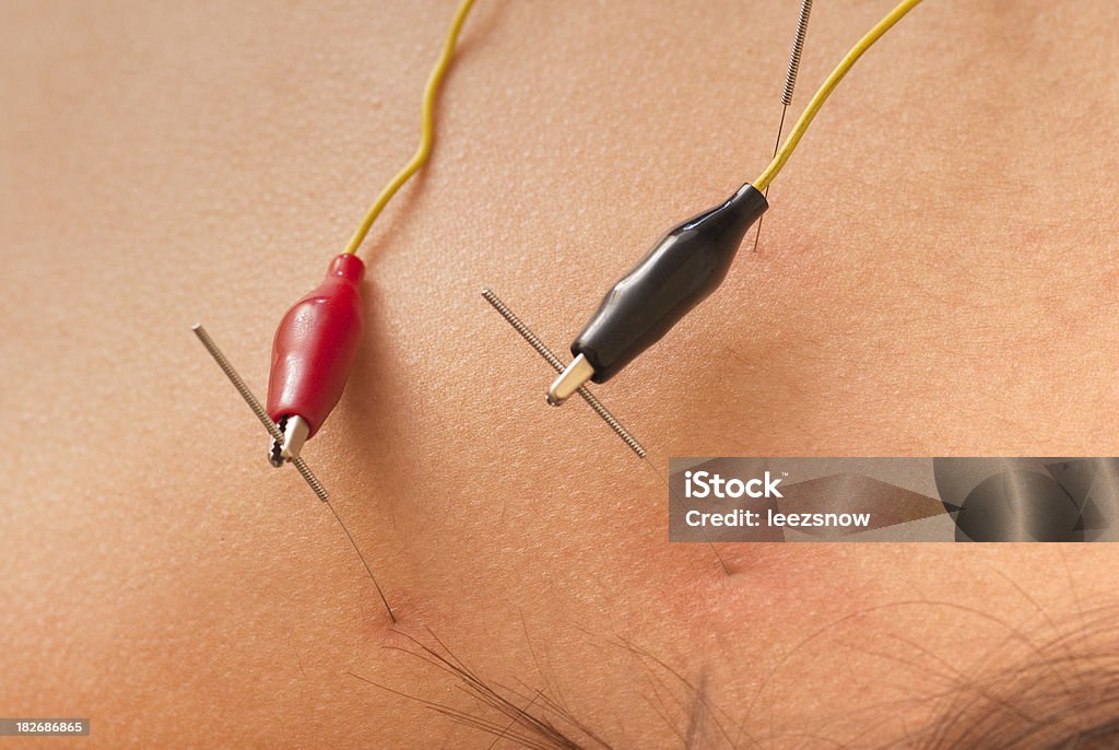 Electrical Stimulation Therapy - Acupuncture Series Electrodes are connected to acupuncture needles for electrical stimulation therapy.Click below for more in this series plus my other acupuncture images: Acupuncture Stock Photo