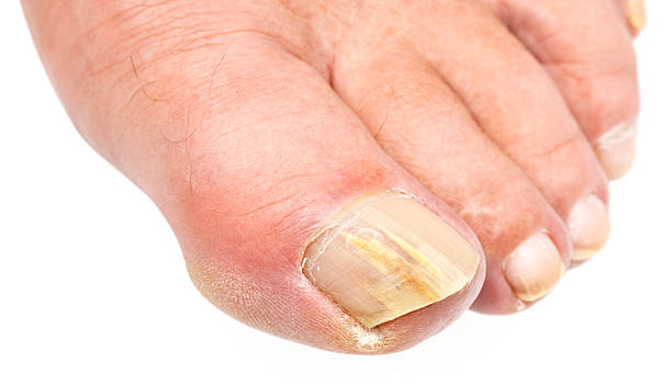 Close-up image of toenail fungus on a white background "Macro close-up of a male foot infected with toenail fungus. Shallow DOF, please zoom in to see the detail. (Canon 5D Mark II, Adobe RGB)Related photos:" toenail stock pictures, royalty-free photos & images