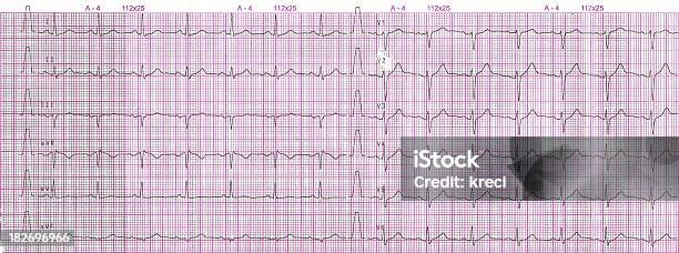 El Electrocardiograma Foto de stock y más banco de imágenes de Latido cardíaco - Latido cardíaco, Aorta, Artículo médico