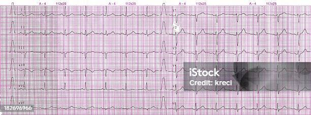 心電図electrocardiogram - 心電図のストックフォトや画像を多数ご用意 - 心電図, ます目, グラフ