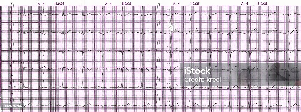 Electrocardiogram - Foto de stock de Ritmo Cardíaco royalty-free