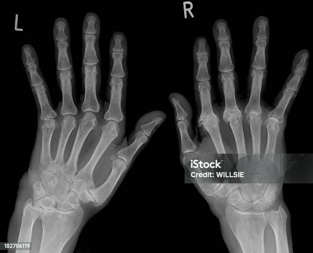 Raiox Digital De Mão Afectada Pela Artrite - Fotografias de stock e mais imagens de Imagem de raios X - Imagem de raios X, Artrite, Articulação - Parte do corpo