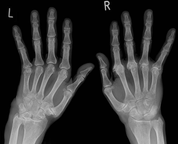 цифровой рентген кистей рук, затронутых артрит - metacarpal стоковые фото и изображения