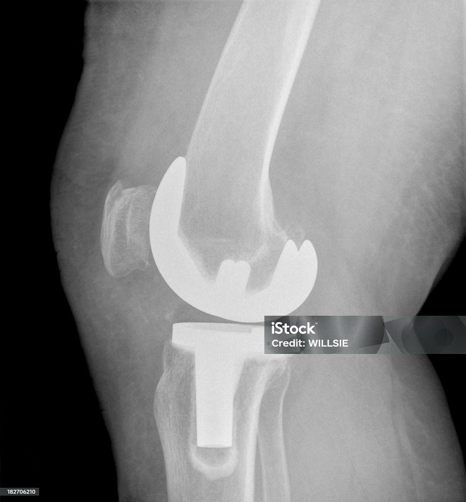 Digital x-ray following successful knee replacement surgery Lateral digital x-ray of a knee showing the normal articulation of the prosthetic components of a total knee replacement. Artificial Knee Stock Photo