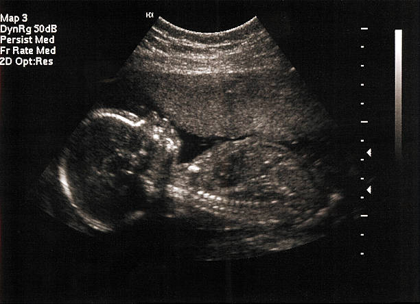 fetus ultrasound at 20 weeks stock photo