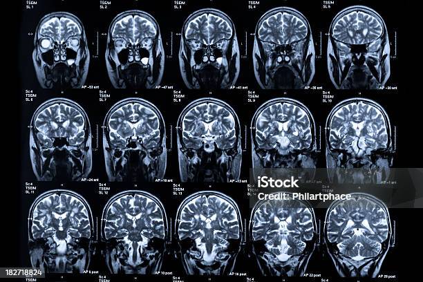 Several Images Of Different Mri Scans In Human Heads Stock Photo - Download Image Now