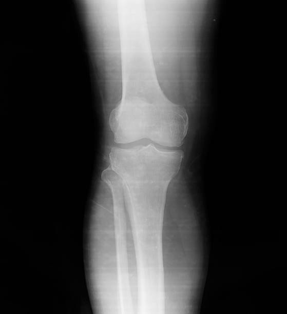 kolano - x ray human knee orthopedic equipment human bone zdjęcia i obrazy z banku zdjęć