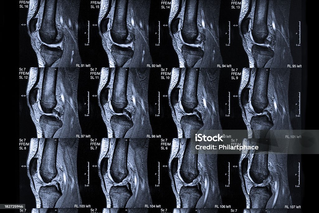 MRI スキャン人間の膝 - MRI検査のロイヤリティフリーストックフォト