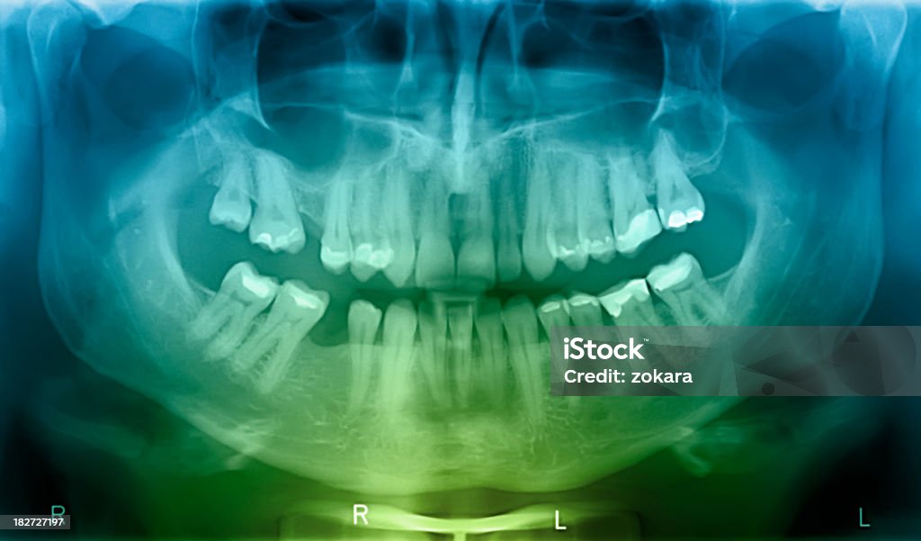 X-ray de boca humana - Foto de stock de Imagen de rayos X libre de derechos