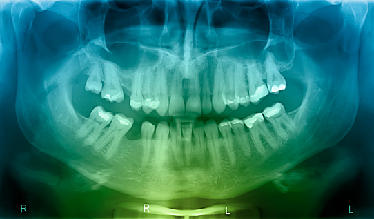 X-ray scan of human jaw with missing teeth.Please see some similar pictures from my portfolio: