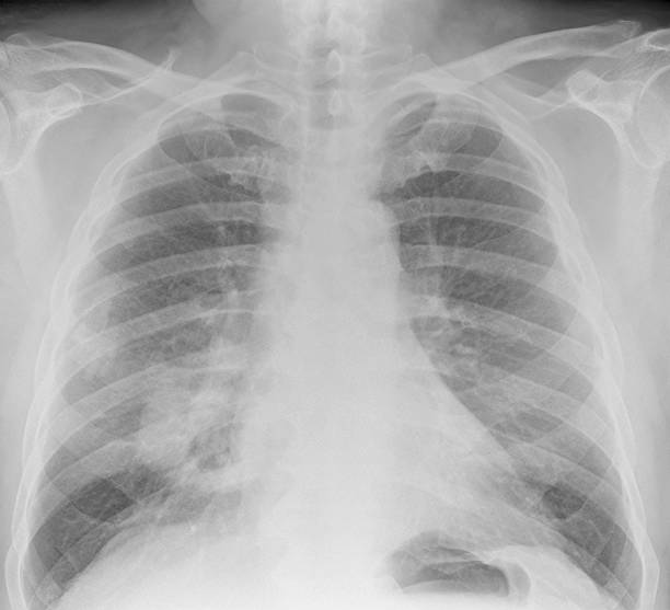 디지탈 흉부 X선 사진 석면 명판 및 폐암 스톡 사진
