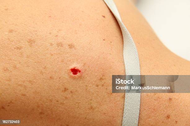 Doctor Removing Mole Stock Photo - Download Image Now - Blood, Color Image, Dermatology