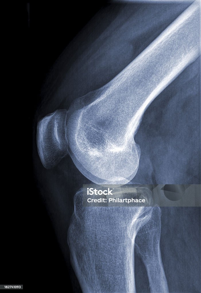 Imagem de raios X Joelho - Royalty-free Articulação - Parte do corpo Foto de stock