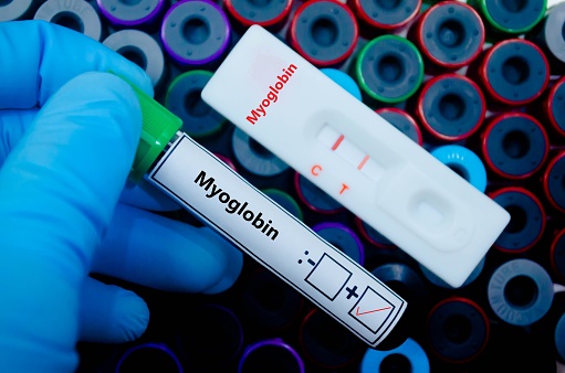 Blood sample of patient positive tested for myoglobin by rapid diagnostic test.