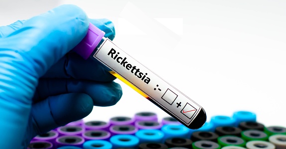 Blood sample of patient positive tested for rickettsia.