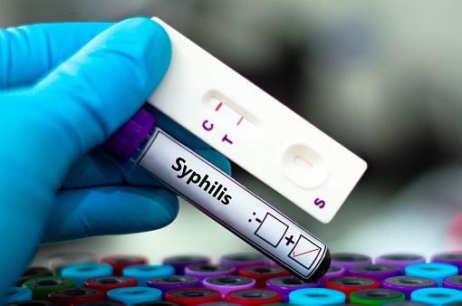 Blood sample of patient positive tested for syphilis by rapid diagnostic test.