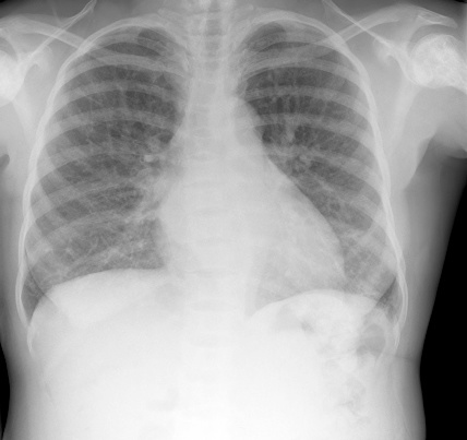 Typical findings on a chest x-ray in sickle cell disease or anaemia, which is an inherited blood disorder, showing a slightly enlarged heart and very dense shoulders from avascular necrosis and end plate depression of vertebrae.