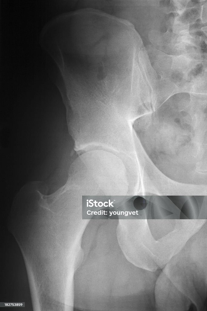 X-레이 선으로나 숫나사 골반 및 넙다리뼈 - 로열티 프리 30-39세 스톡 사진