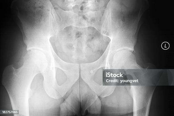 X Ray Of A 雄骨盤および大腿骨 - 30代のストックフォトや画像を多数ご用意 - 30代, 30代の男性, X線撮影