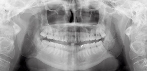 디지탈 orthopantomogram x-레이 조 표시중 골절 스톡 사진
