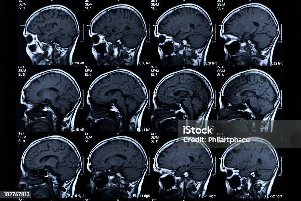 Foto de Exame De Ressonância Magnética Cabeça Humana e mais fotos de stock de Exame de ressonância magnética - Exame de ressonância magnética, Derrame Cerebral, Doença de Alzheimer