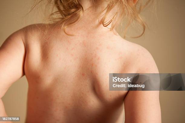Kleines Mädchen Mit Rash Von Allergische Reaktion Auf Antibiotikum Stockfoto und mehr Bilder von Nesselsucht