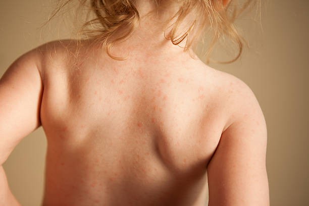 Little Girl with Rash from Allergic Reaction to Antibiotic stock photo