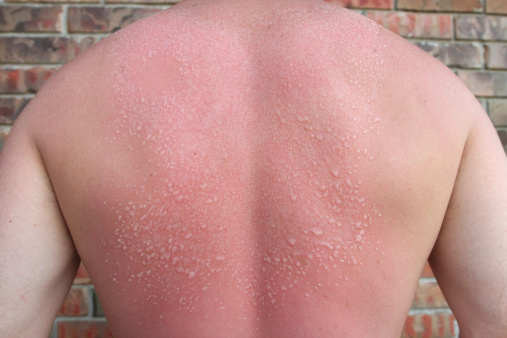 A sunburn with blisters on a male back.