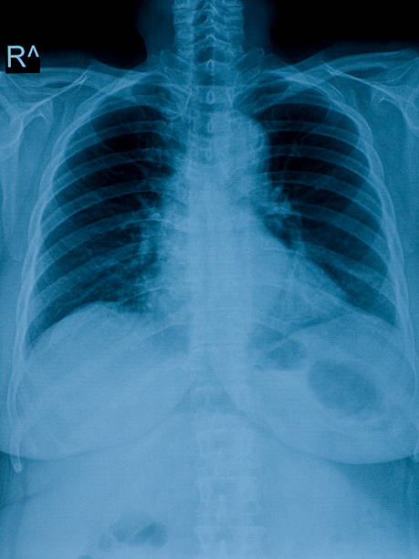 istock X-ray image of human chest 182795446
