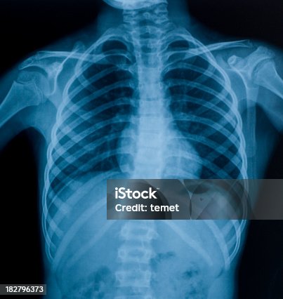 istock X-ray image of chest 182796373