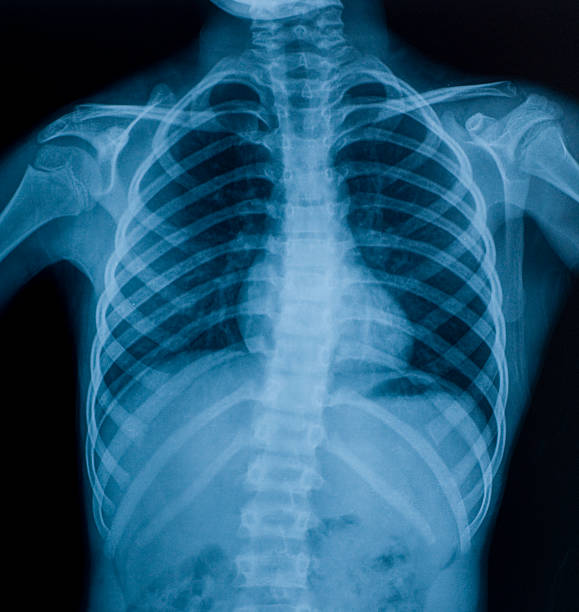 X-ray image of chest X-ray image of chest x ray image stock pictures, royalty-free photos & images