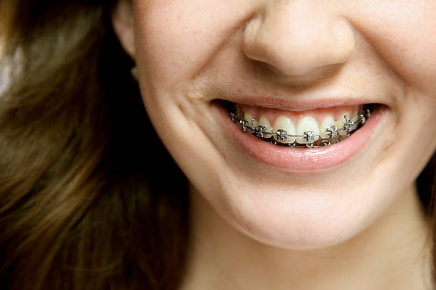 Dental braces stock photo