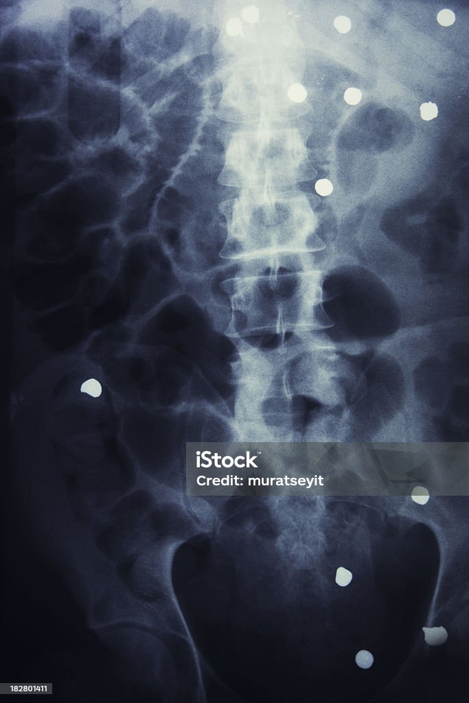 Fotografía de un tiro desde el abdomen - Foto de stock de Imagen de rayos X libre de derechos