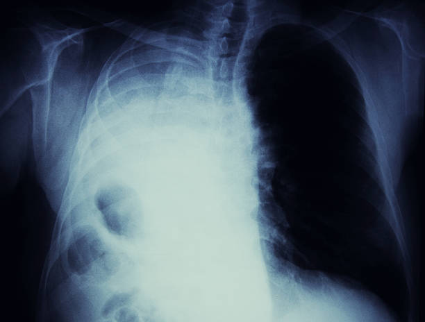 raggi x di un affondo cancro e gestione - rib cage people x ray image x ray foto e immagini stock