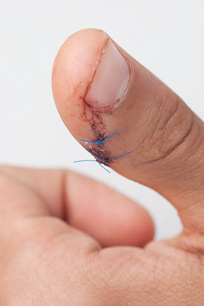 Thumb with suture wound after surgery stock photo