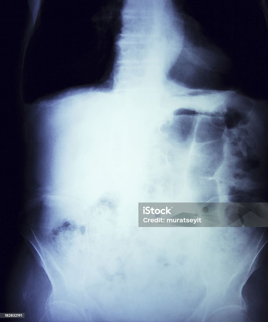 Bauch und Lunge x-ray - Lizenzfrei Anatomie Stock-Foto