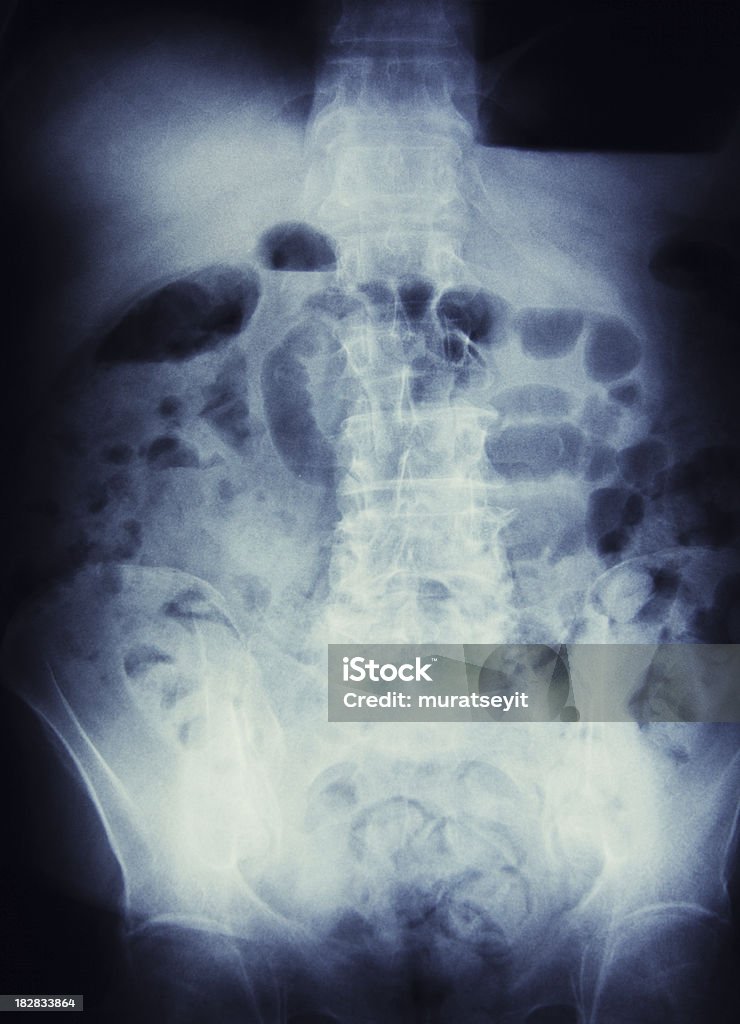 x-ray of Кишечная непроходимость - Стоковые фото Анатомия роялти-фри