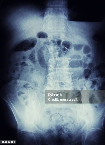 Xray Of Кишечная Непроходимость — стоковые фотографии и другие картинки Анатомия - Анатомия, Вертикальный, Грудь