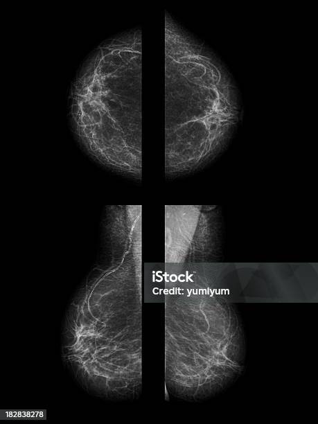 マモグラフィー - マモグラフィーのストックフォトや画像を多数ご用意 - マモグラフィー, X線撮影, ヘルスケアと医療
