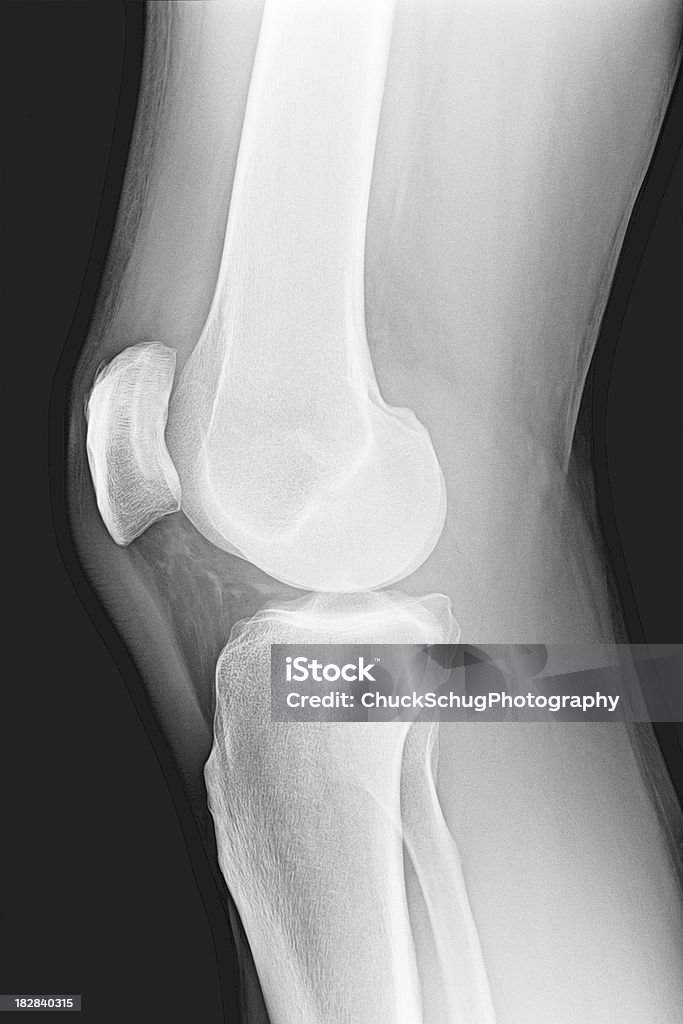 Knie Anatomie Knochen Menschliches Bein X-Ray - Lizenzfrei Knochenmark-Gewebe Stock-Foto