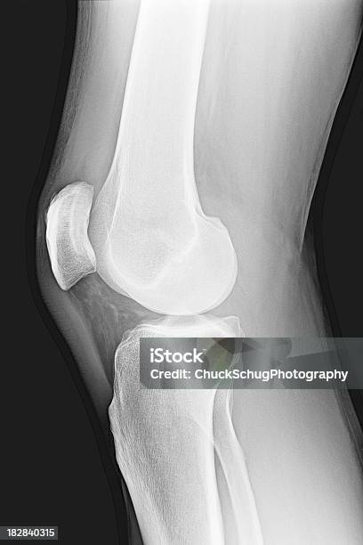 Knie Anatomie Knochen Menschliches Bein Xray Stockfoto und mehr Bilder von Knochenmark-Gewebe - Knochenmark-Gewebe, Epiphyse, Medizinisches Röntgenbild