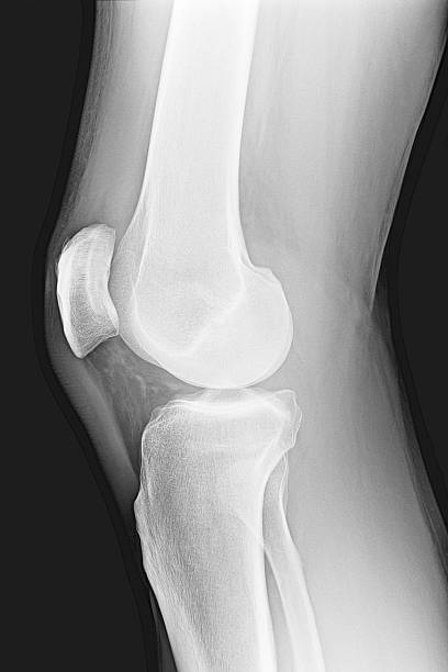 膝の部位の x 線骨人の脚 - lateral condyle ストックフォトと画像