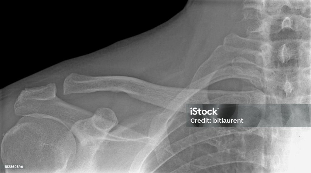 RX spalla - Lizenzfrei Anatomie Stock-Foto